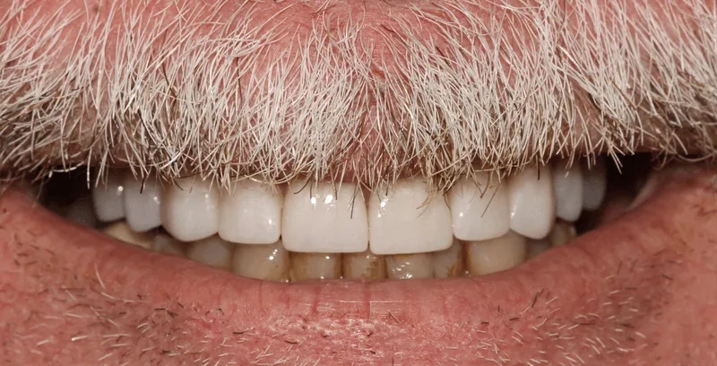Porcelain Veneers Smile After