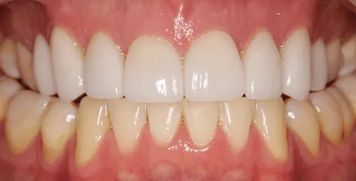 Upper Veneers Smile After