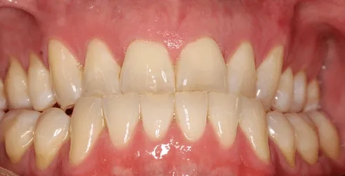 Upper Veneers Smile Before