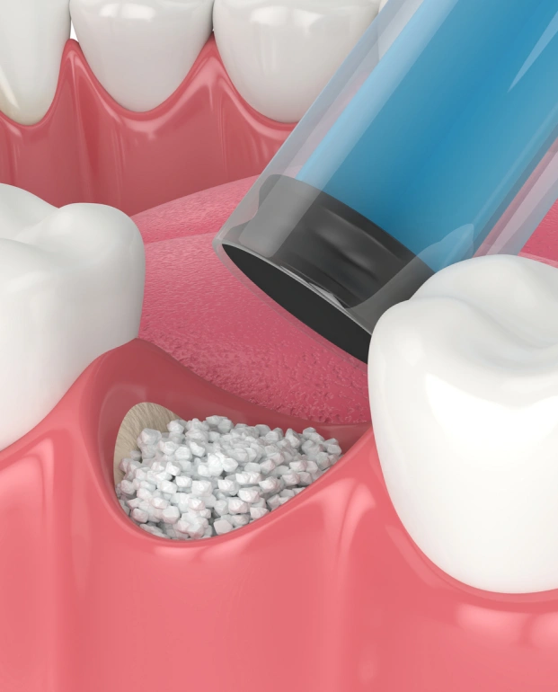 Prepare for Dental Implants with Bone Grafting