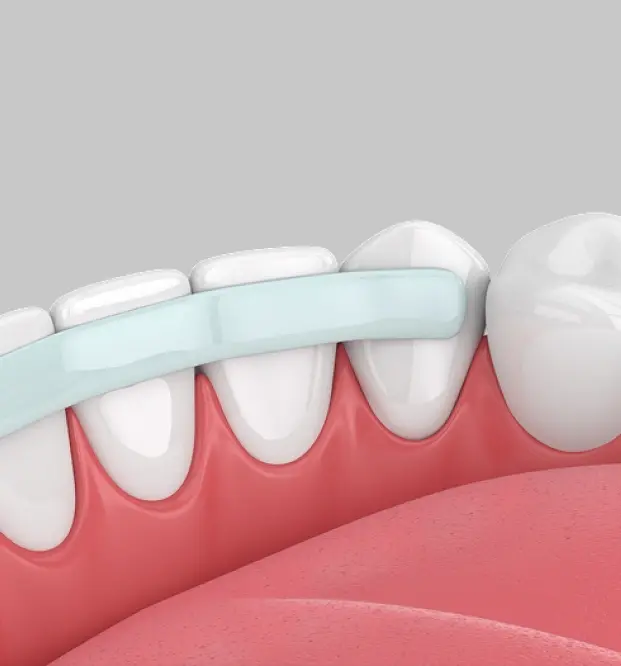 Dental bonding illustration showing a toothbrush cleaning white bonded teeth with pink gums.