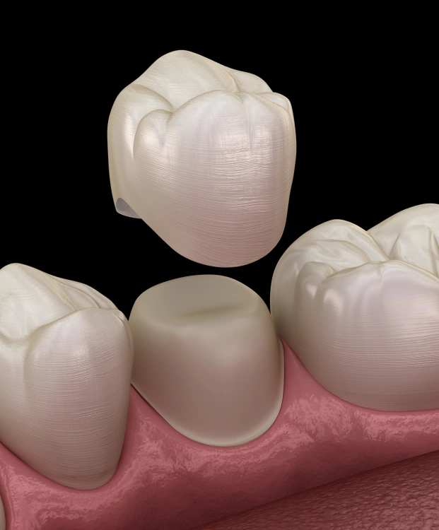 Restoring Strength and Function to a Damaged Tooth