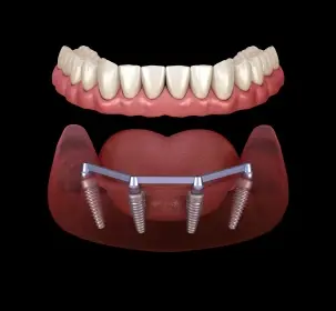 All-on-4 dental implants diagram showing prosthetic teeth and implant posts in jawbone model.