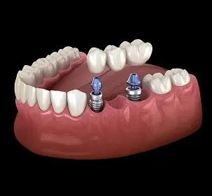 Implant-supported bridge illustration showing two dental implants with crown restoration in the upper jaw.