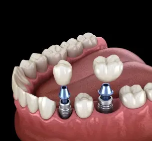 Multiple dental implants with blue abutments replacing missing teeth in lower jaw.