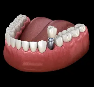 3D illustration of a single dental implant replacing a missing tooth in the upper jaw.
