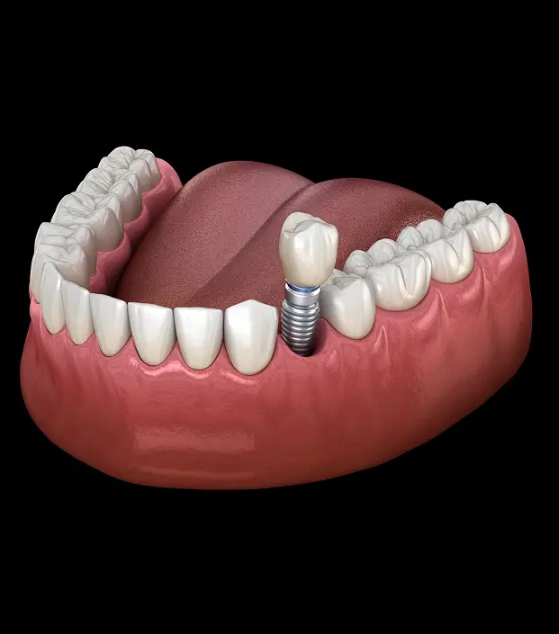 Dental implant illustration showing a single tooth implant fixture integrated into the jawbone with natural teeth.