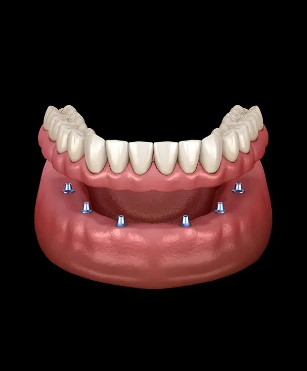 Implant-supported denture with six blue dental implants anchoring a full arch of replacement teeth.