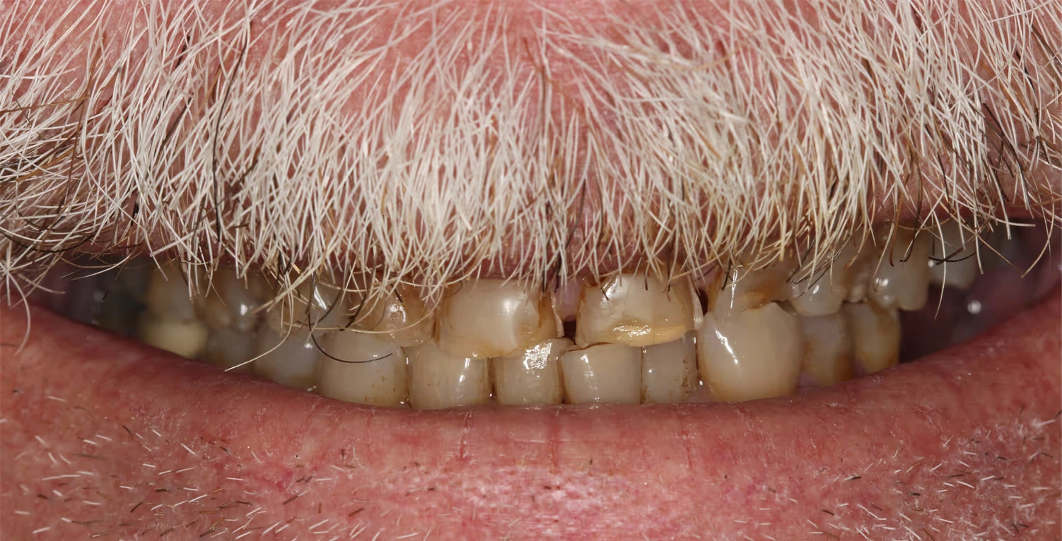 Porcelain Veneers Smile Before