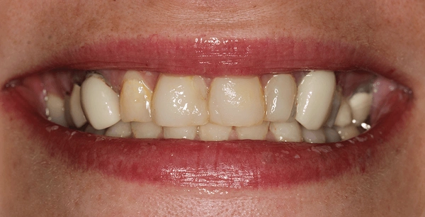 Eight porcelain veneers to improve aesthetics before